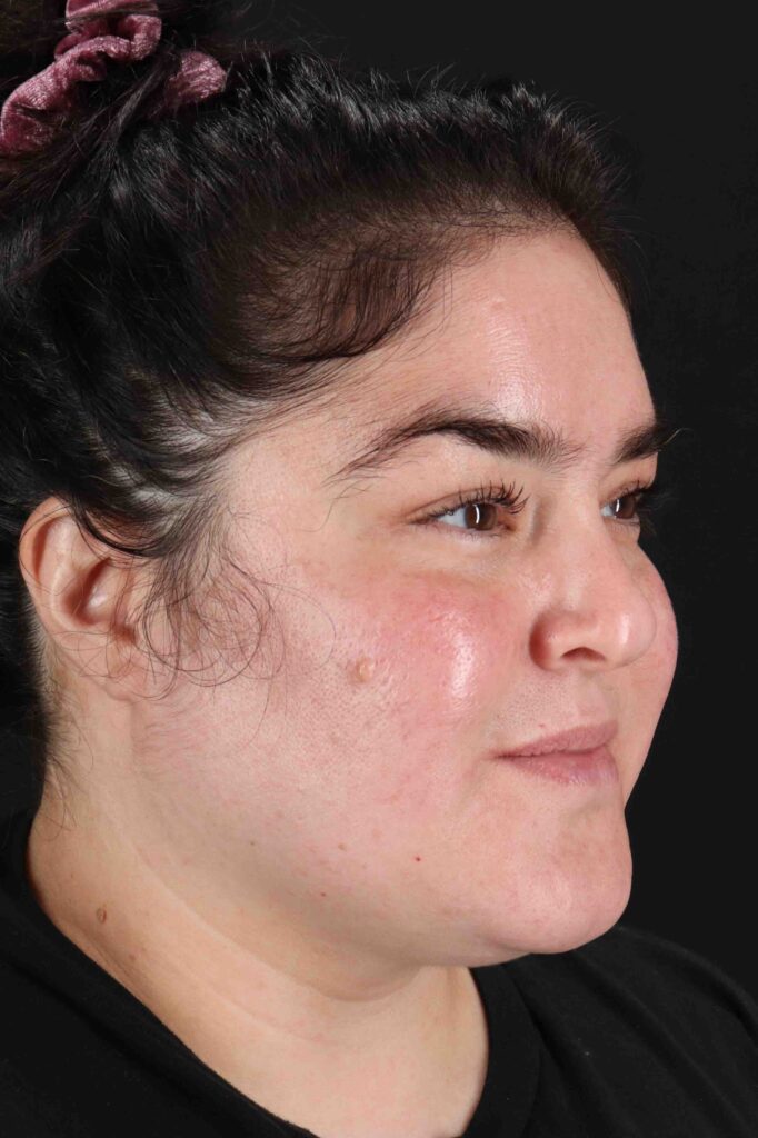 Before - right_oblique