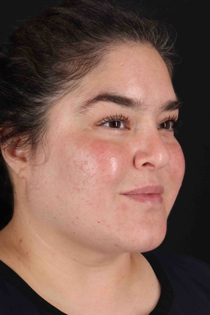 After - right_oblique