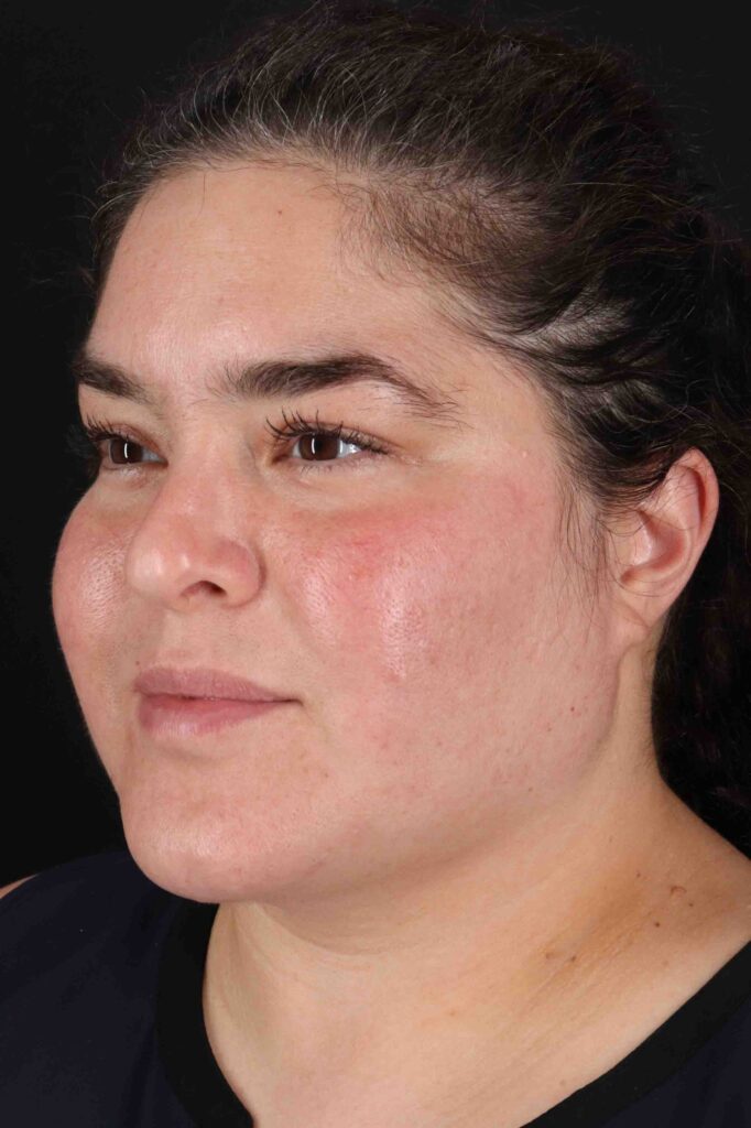 After - left_oblique