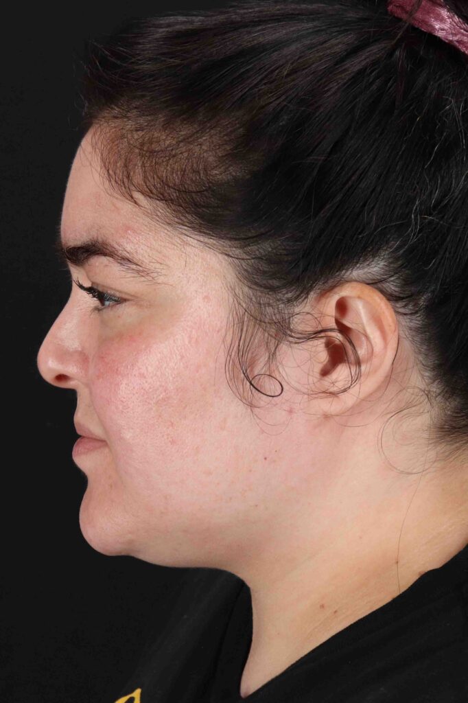 Before - left_lateral