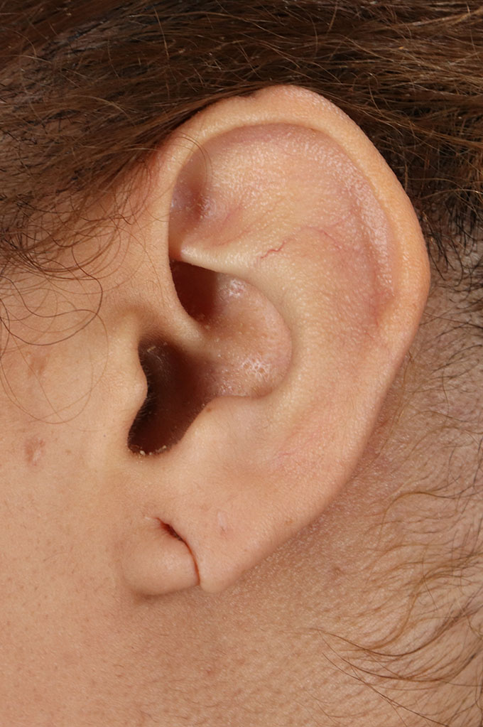 Before - left_lateral