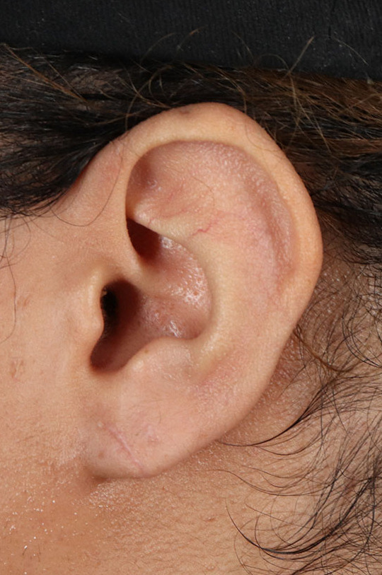 After - left_lateral