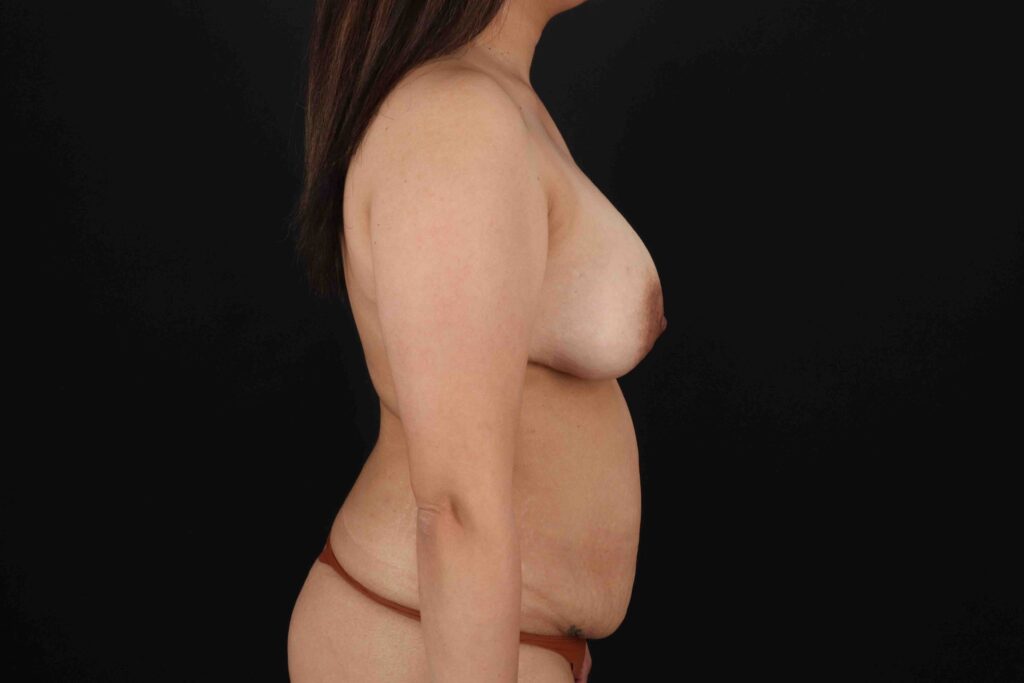 Before - right_lateral