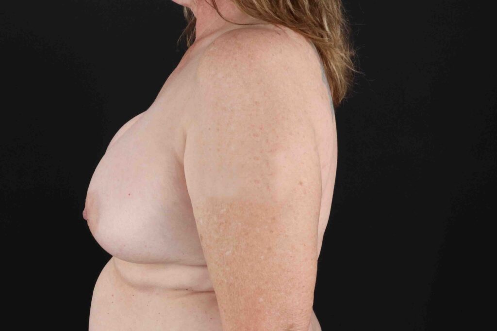 Before - left_lateral