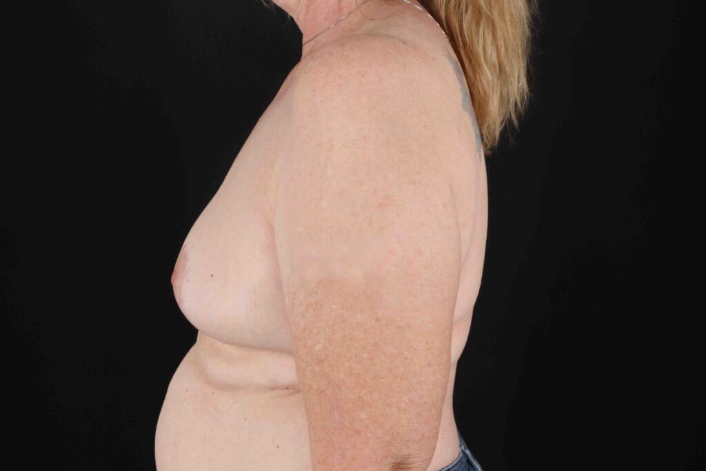 After - left_lateral