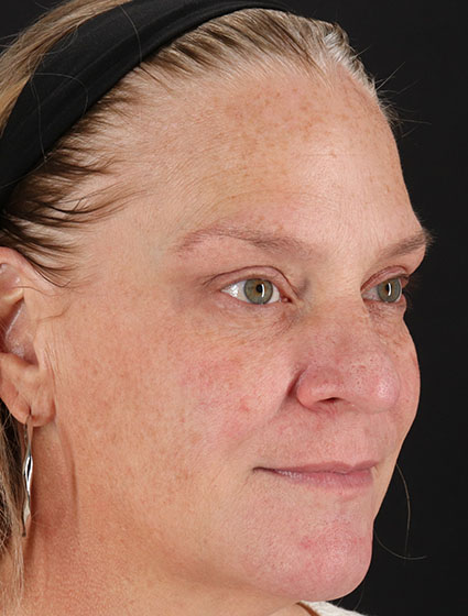 Before - right_oblique