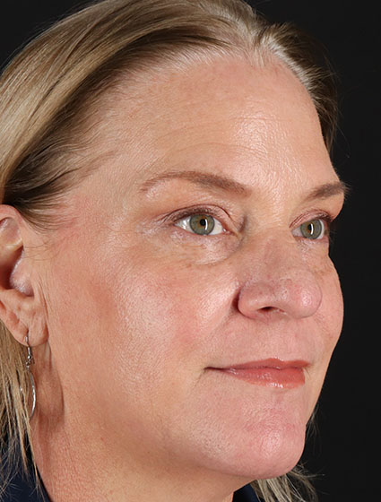 After - right_oblique