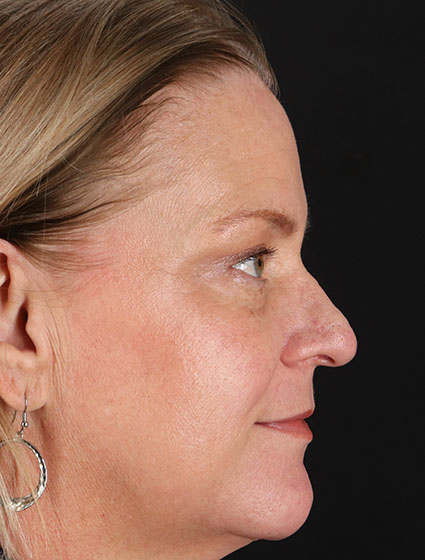 After - right_lateral