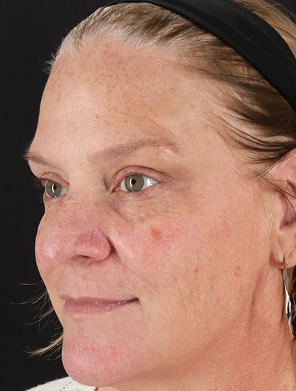 Before - left_oblique