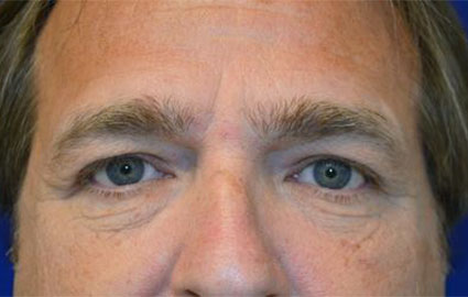 Before - 00716
