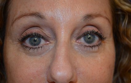 Before - 00711