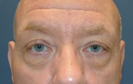 Before - 00709