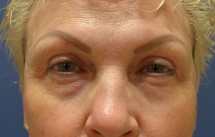 Before - 00708