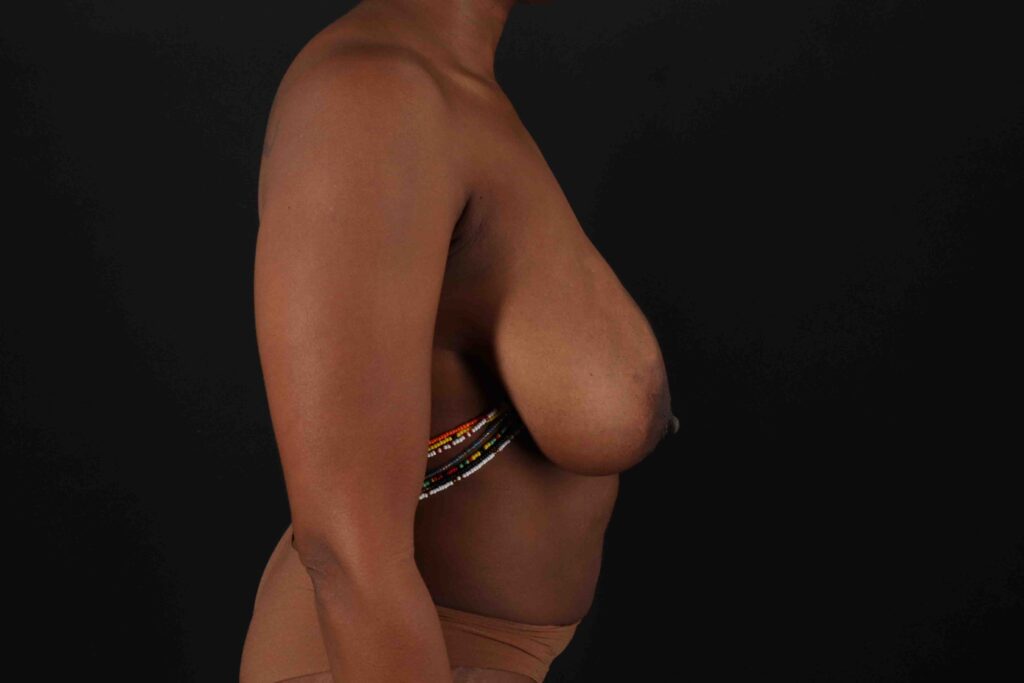 Before - right_lateral