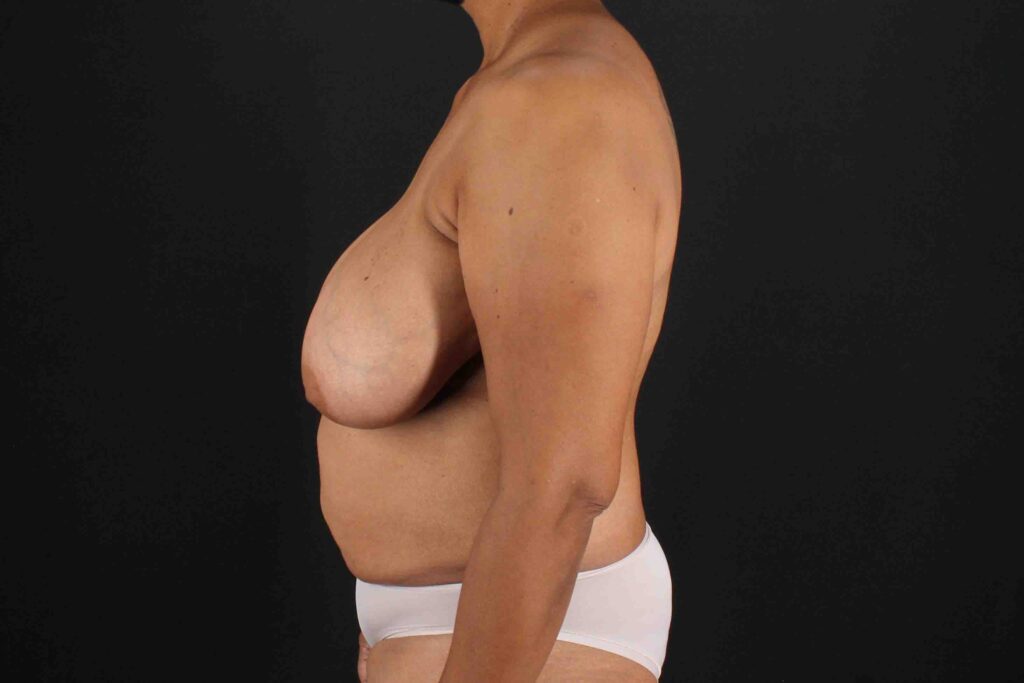 Before - left_lateral