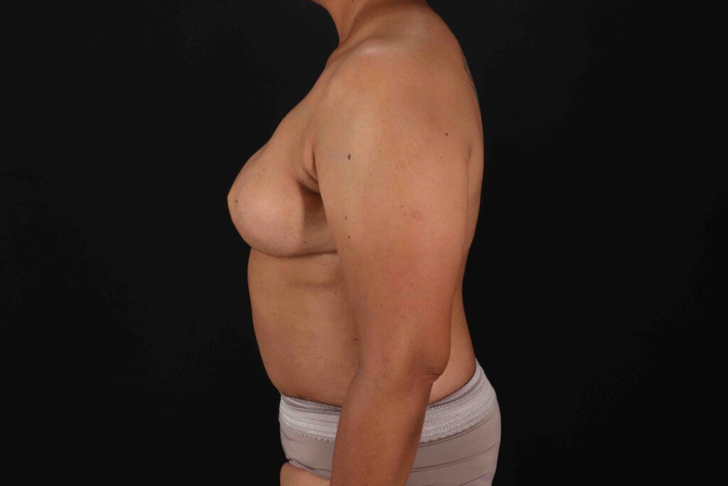 After - left_lateral