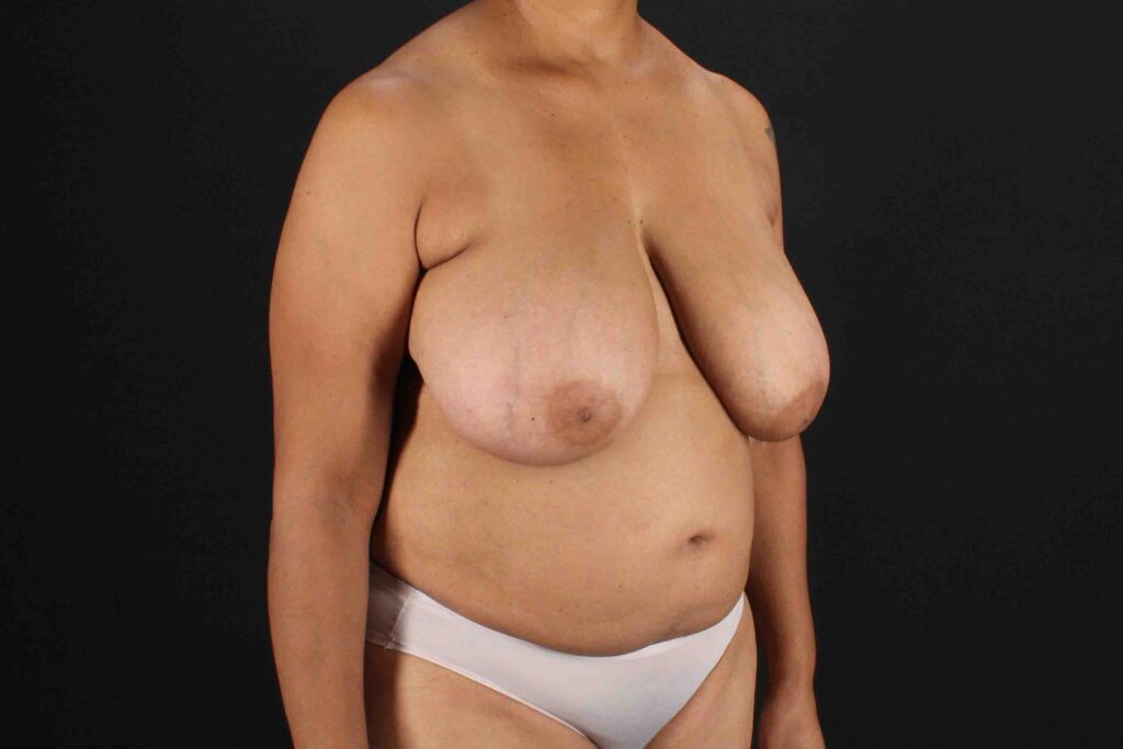 Before - right_oblique