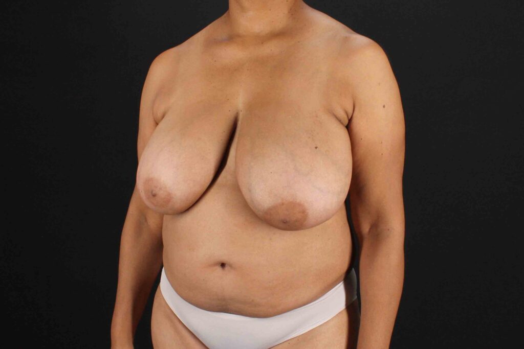 Before - left_oblique