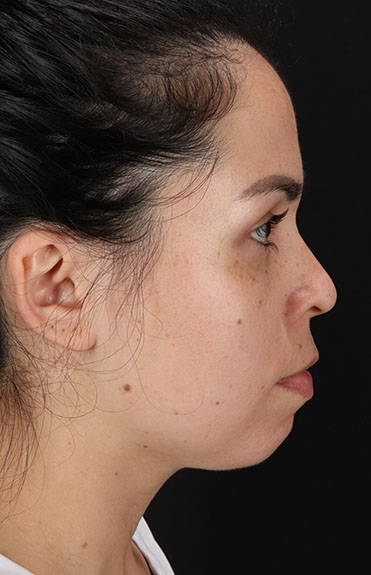 After - right_lateral