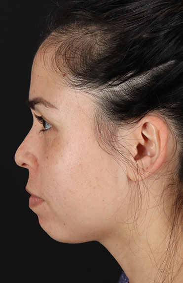 Before - left_lateral