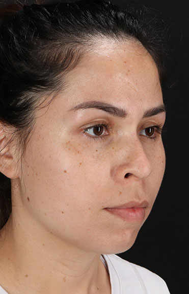 After - right_oblique