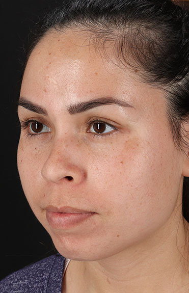 Before - left_oblique