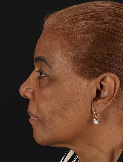 Before - left_lateral