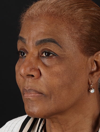 Before - left_oblique