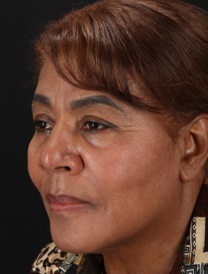 After - left_oblique