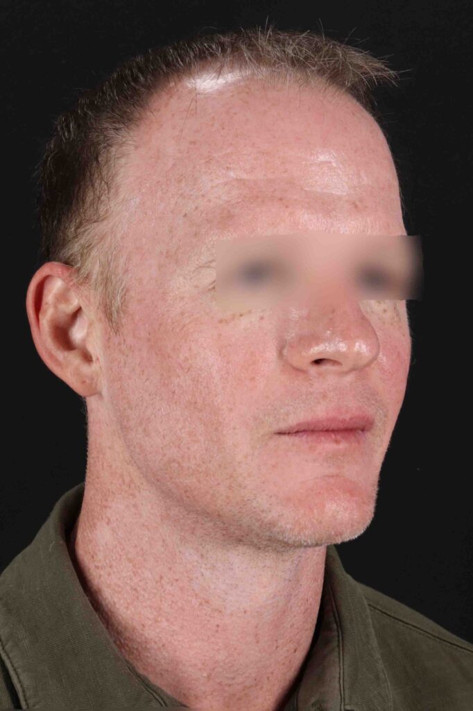 After - right_oblique