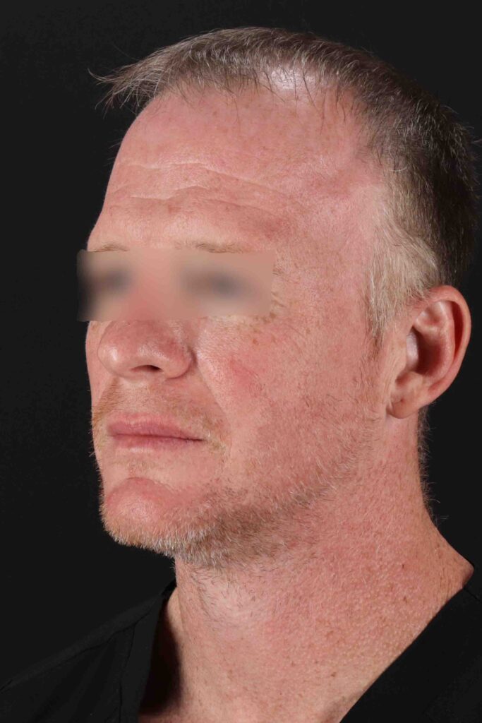 Before - left_oblique