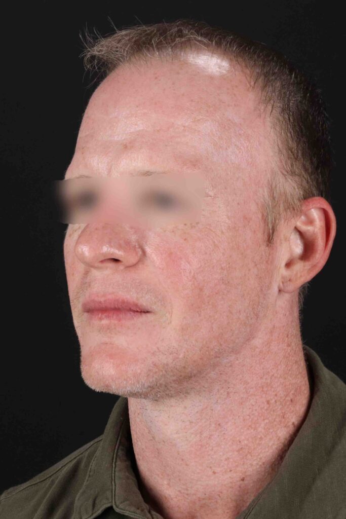 After - left_oblique