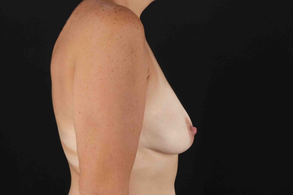 Before - right_lateral