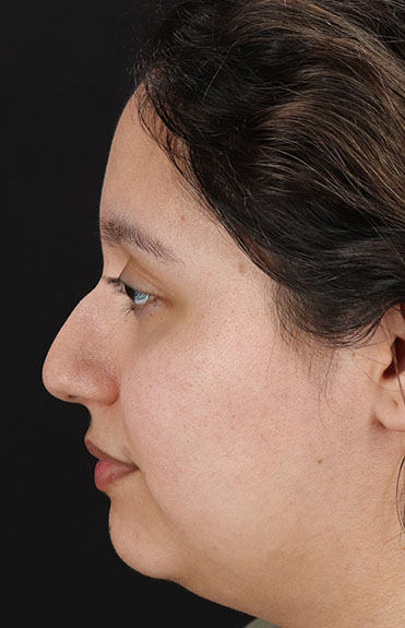 Before - left_lateral