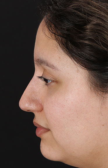 After - left_lateral