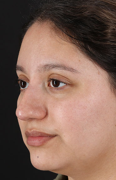 After - left_oblique