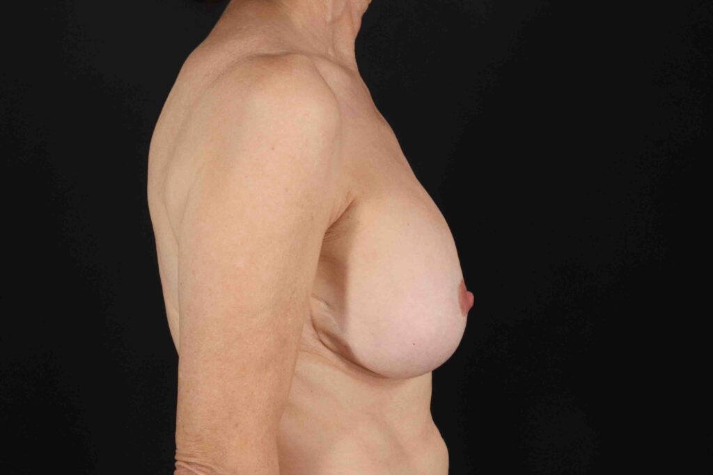 Before - right_lateral