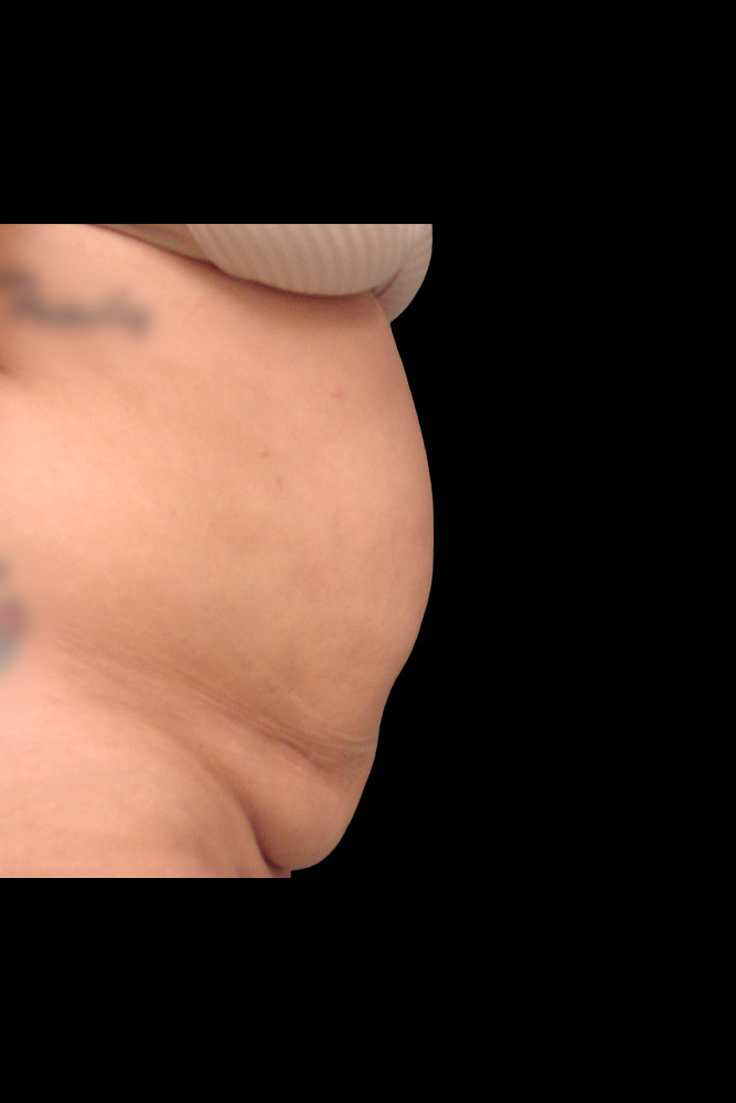 Before - right_lateral