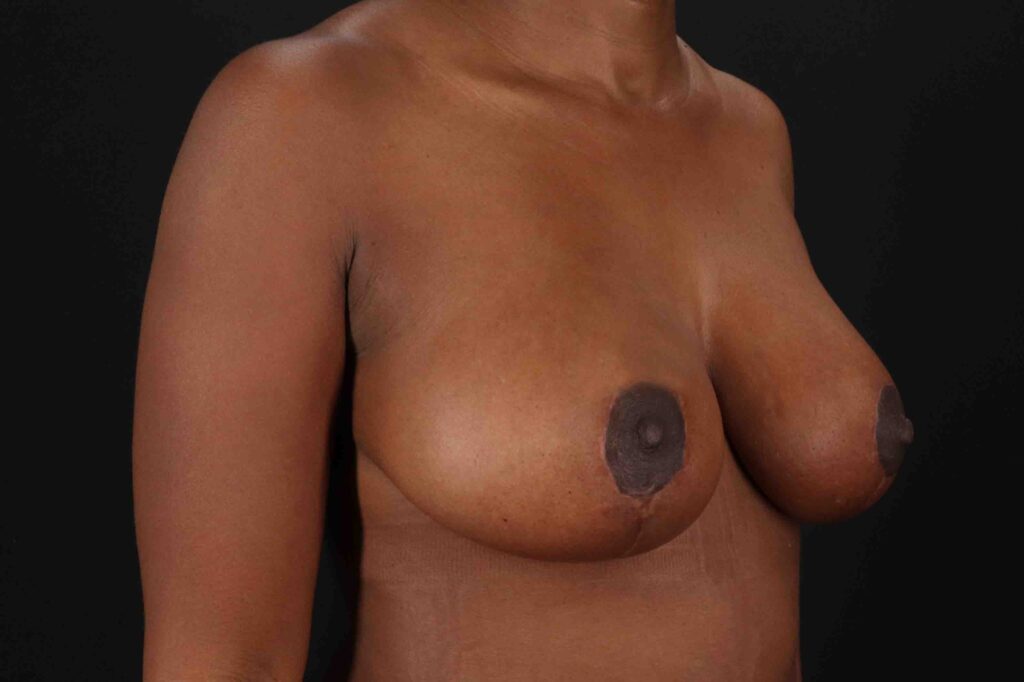 After - right_oblique