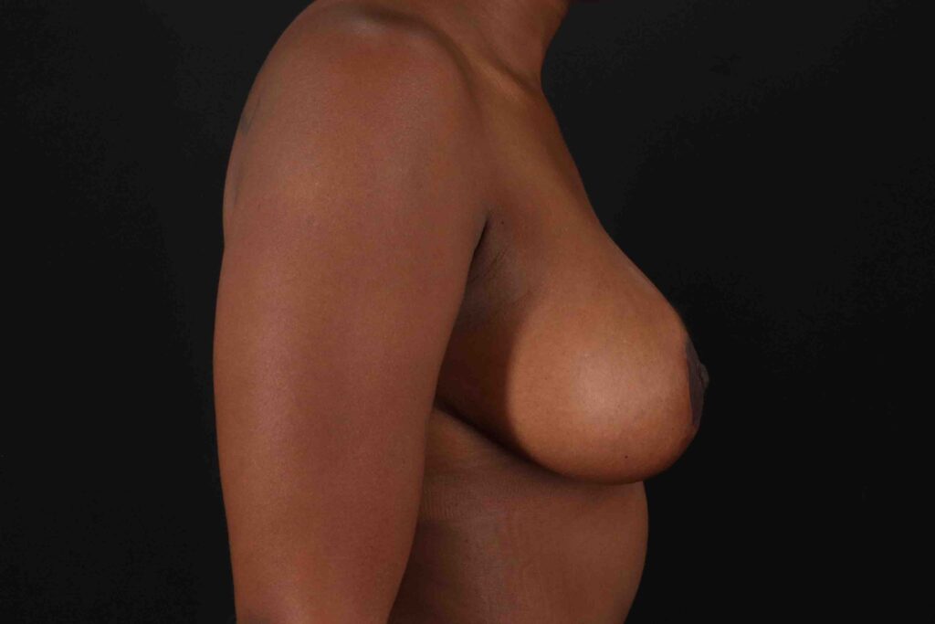 After - right_lateral