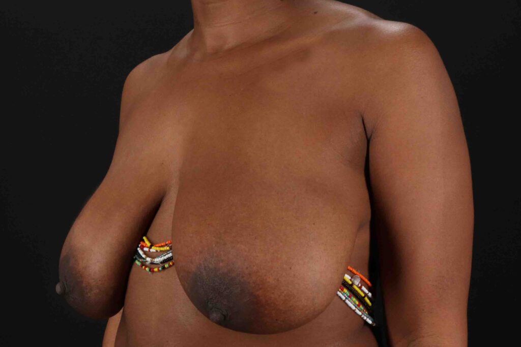 Before - left_oblique