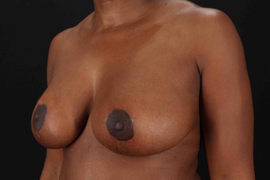 After - left_oblique