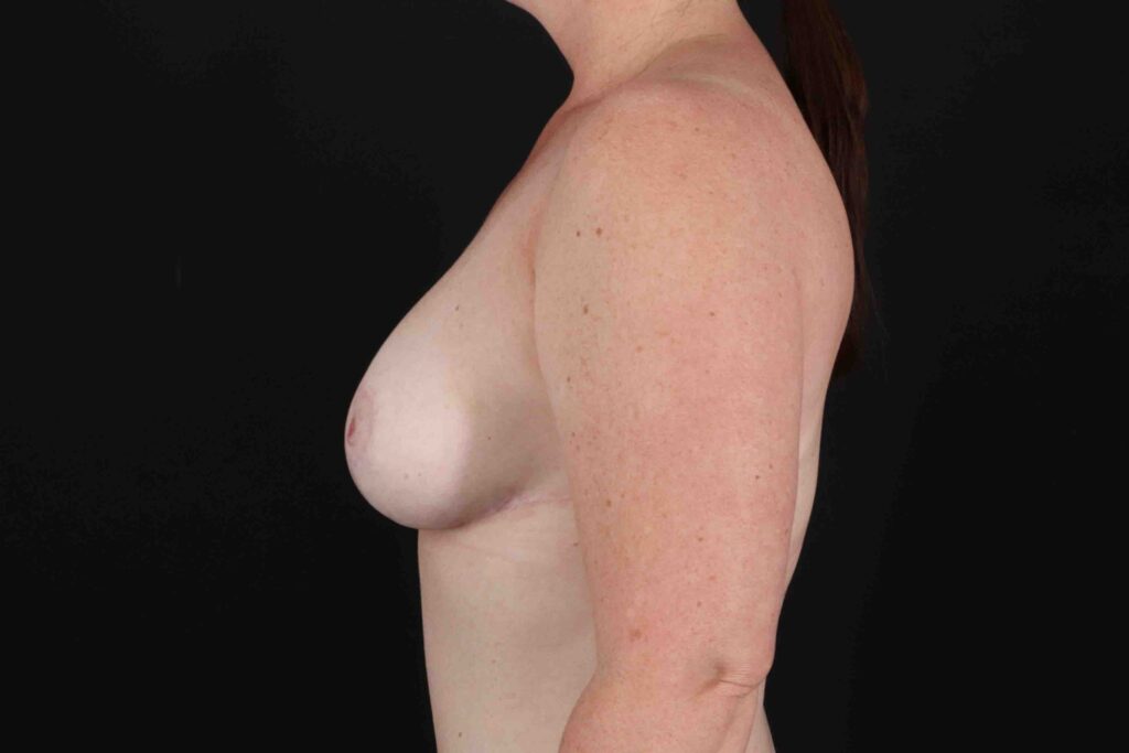 After - left_lateral