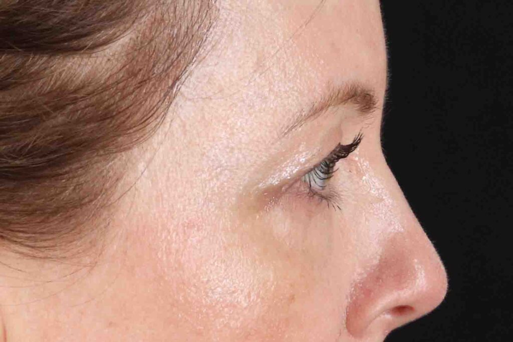 Before - right_lateral