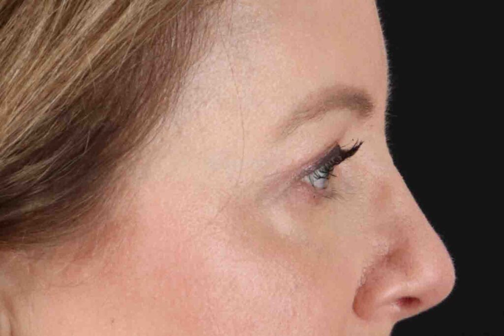 After - right_lateral