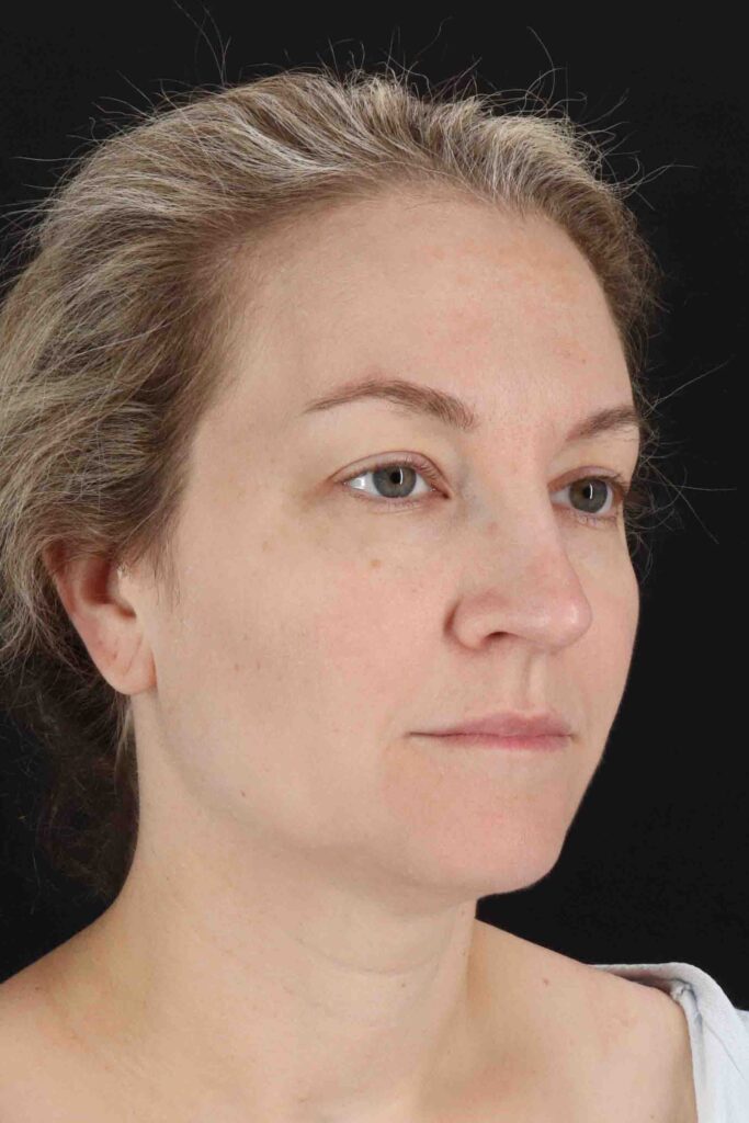 Before - right_oblique