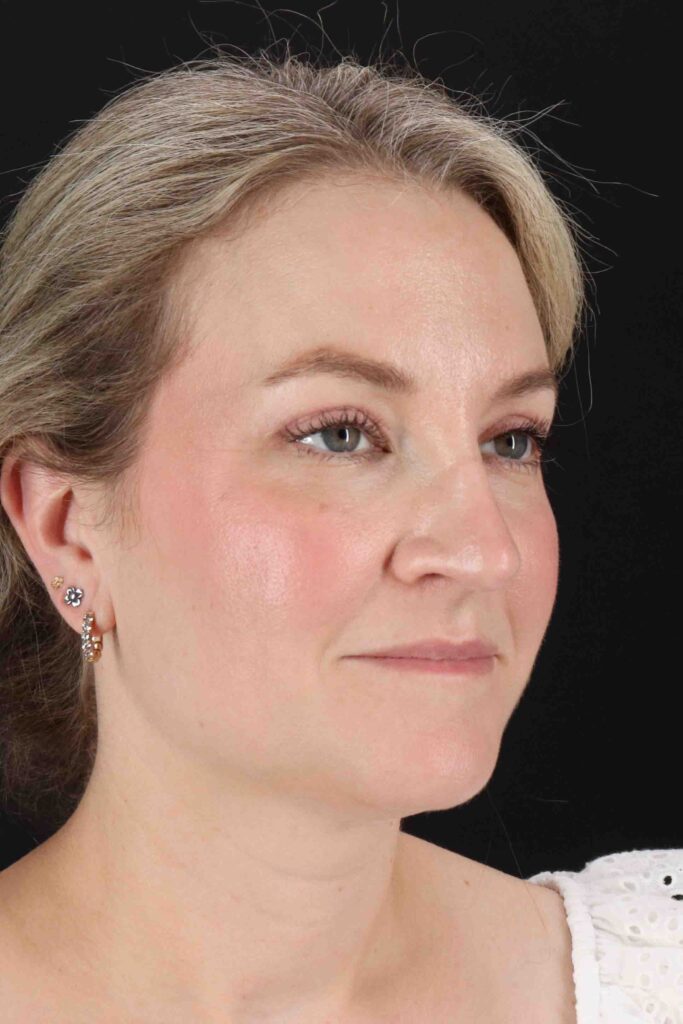 After - right_oblique