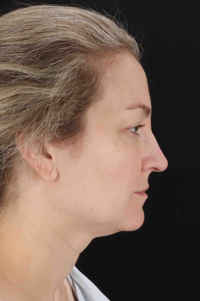 Before - right_lateral