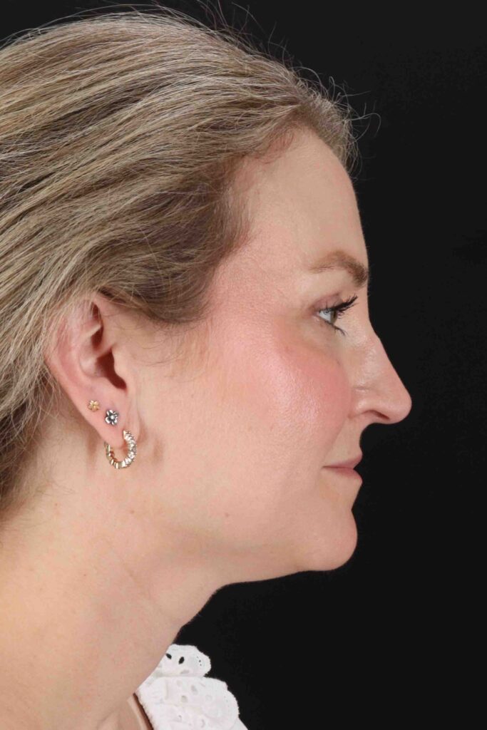 After - right_lateral