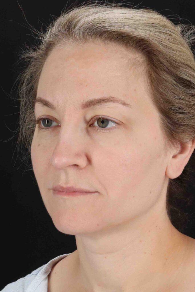 Before - left_oblique